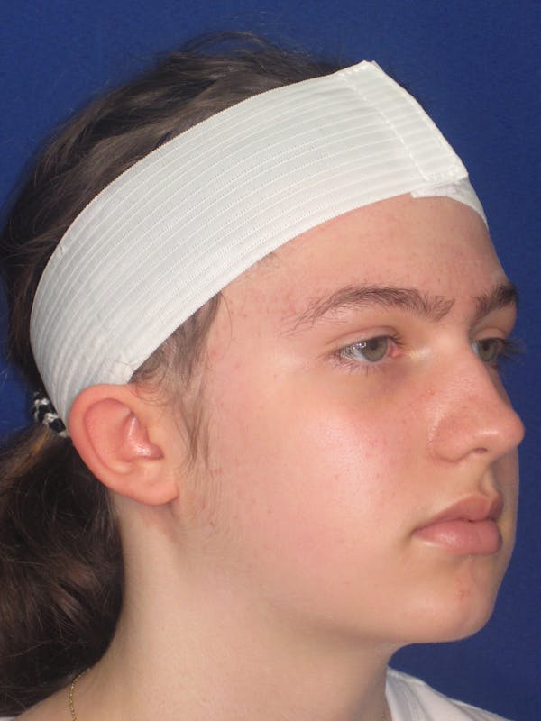 Otoplasty 