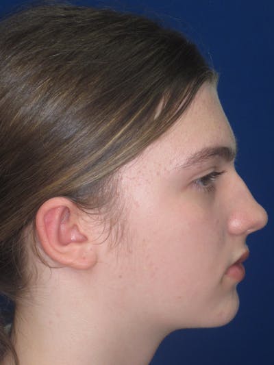 Otoplasty 