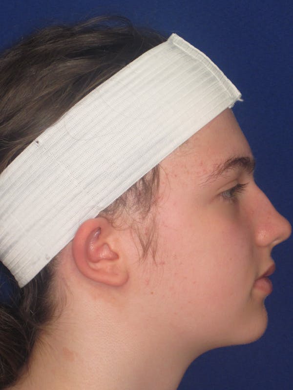 Otoplasty 