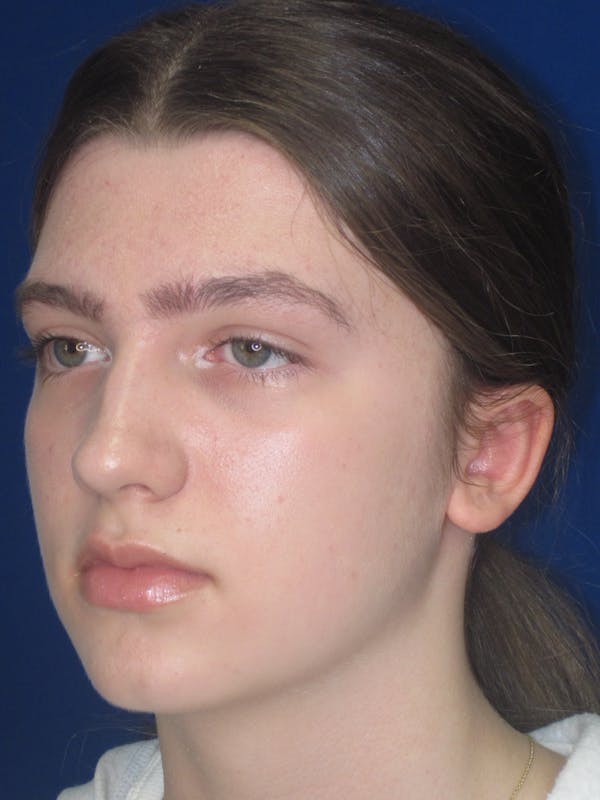 Otoplasty 