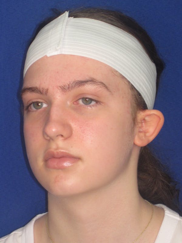 Otoplasty 