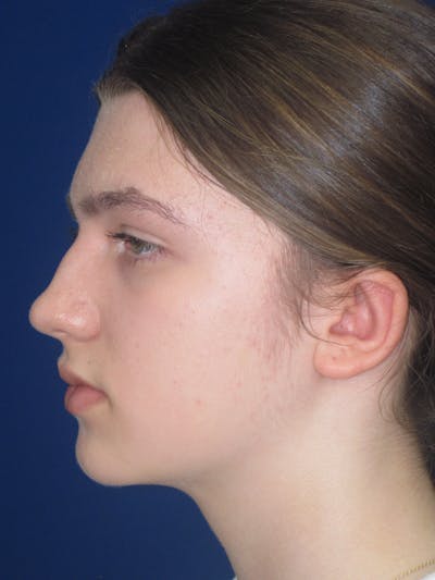 Otoplasty 
