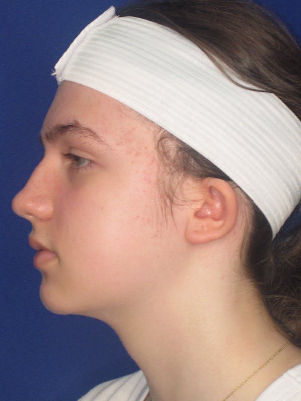 Otoplasty 