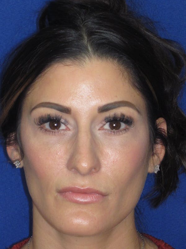Rhinoplasty Before & After Gallery - Patient 279273 - Image 7