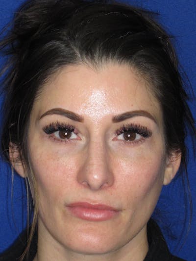 Rhinoplasty Before & After Gallery - Patient 279273 - Image 8