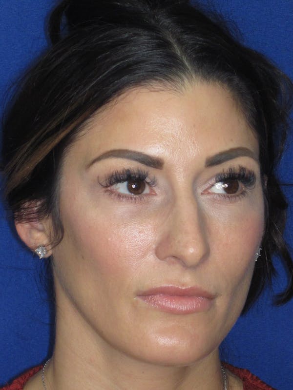Rhinoplasty Before & After Gallery - Patient 279273 - Image 5