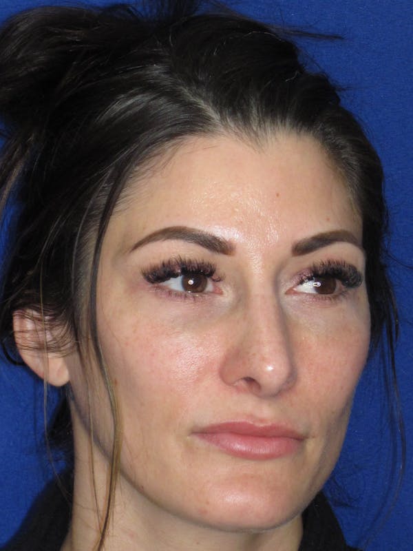 Rhinoplasty Before & After Gallery - Patient 279273 - Image 6