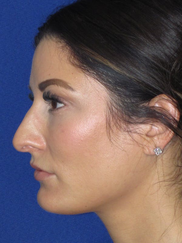 Rhinoplasty Before & After Gallery - Patient 279273 - Image 3