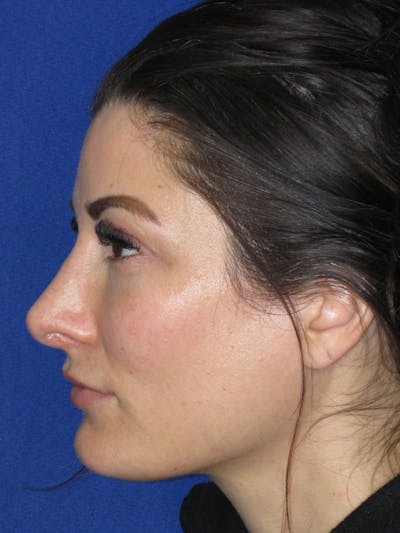 Rhinoplasty Before & After Gallery - Patient 279273 - Image 4