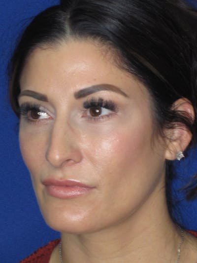 Rhinoplasty Before & After Gallery - Patient 279273 - Image 1