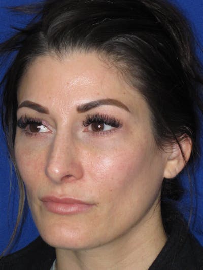 Rhinoplasty Before & After Gallery - Patient 279273 - Image 2