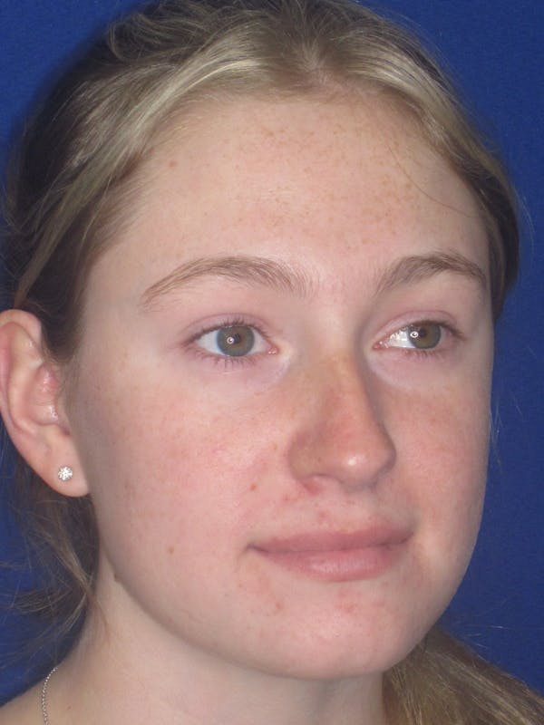 Rhinoplasty Before & After Gallery - Patient 902733 - Image 7