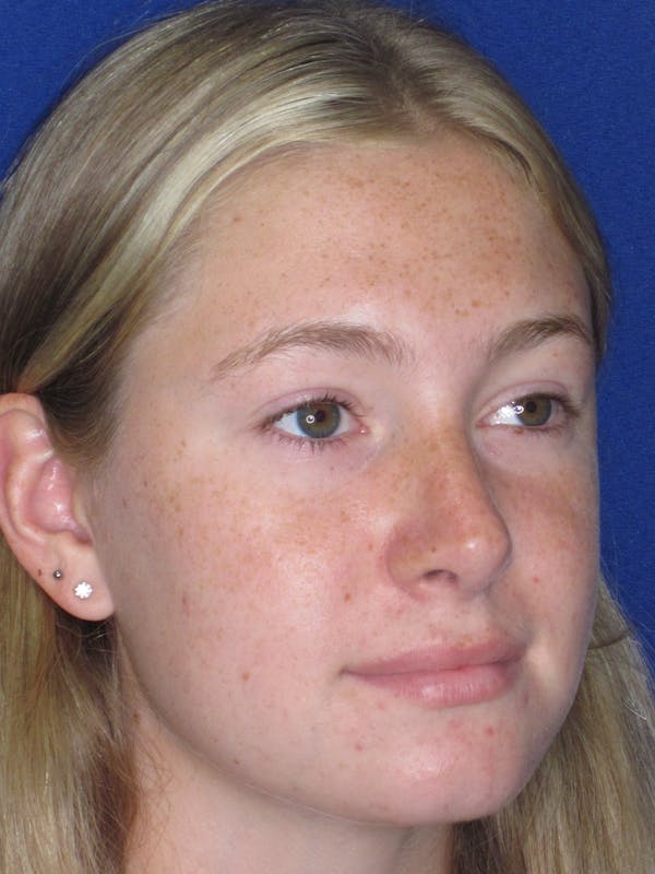 Rhinoplasty Before & After Gallery - Patient 902733 - Image 8