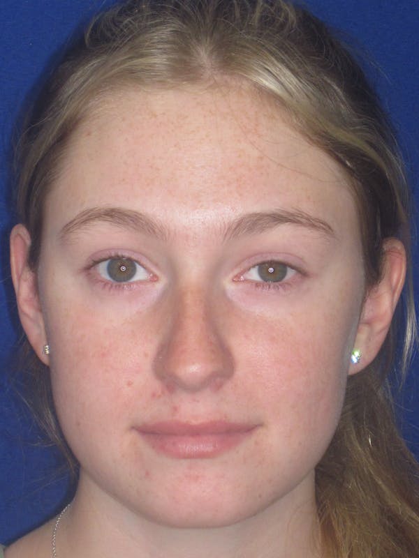 Rhinoplasty Before & After Gallery - Patient 902733 - Image 5