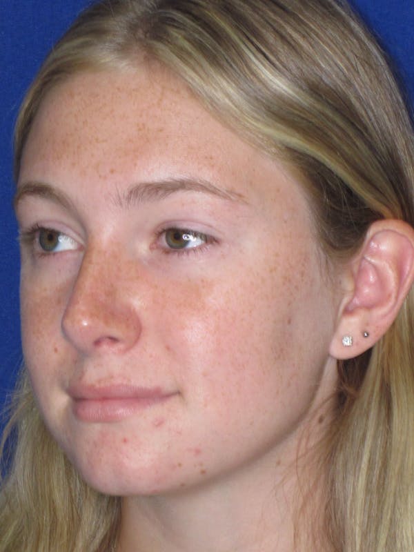 Rhinoplasty Before & After Gallery - Patient 902733 - Image 4