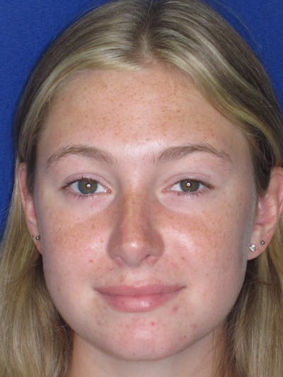 Rhinoplasty Before & After Gallery - Patient 902733 - Image 6