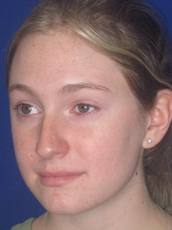 Rhinoplasty Before & After Gallery - Patient 902733 - Image 3