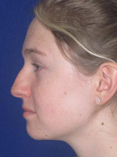 Rhinoplasty Before & After Gallery - Patient 902733 - Image 1