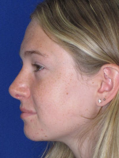 Rhinoplasty Before & After Gallery - Patient 902733 - Image 2