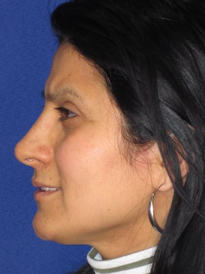 Rhinoplasty Before & After Gallery - Patient 303440 - Image 2
