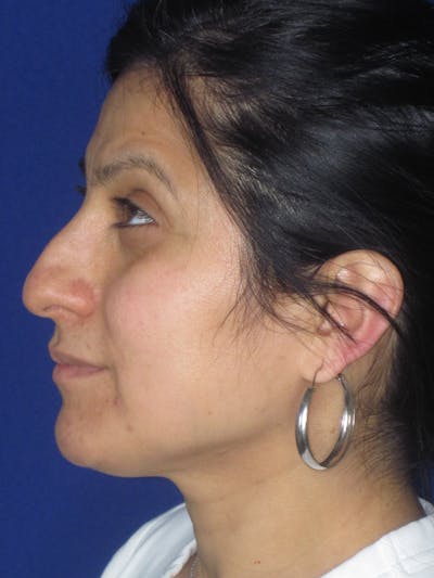 Rhinoplasty Before & After Gallery - Patient 303440 - Image 1