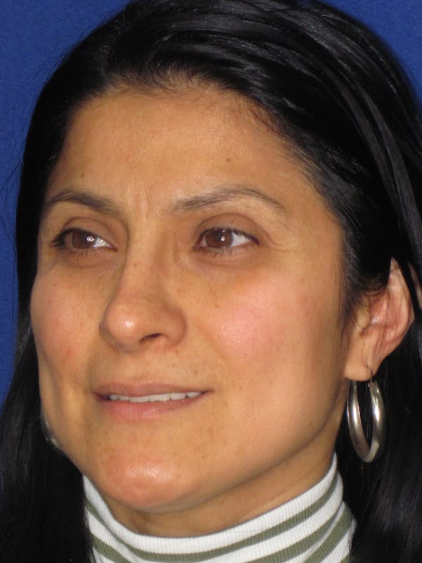Rhinoplasty Before & After Gallery - Patient 303440 - Image 4