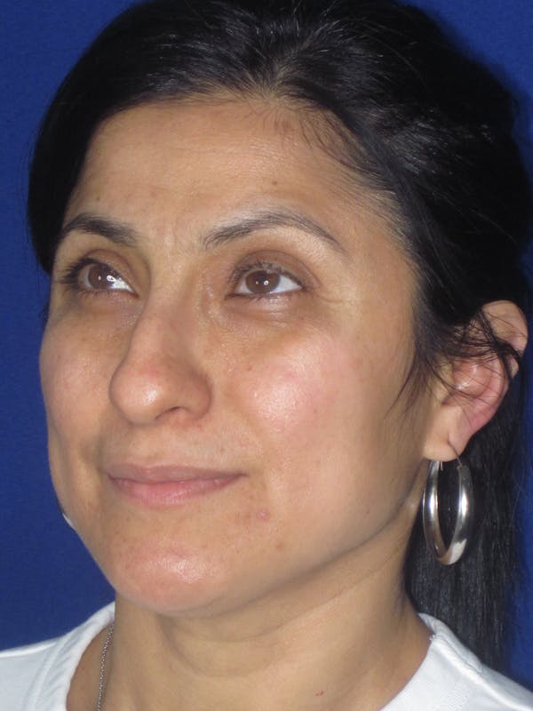 Rhinoplasty Before & After Gallery - Patient 303440 - Image 3