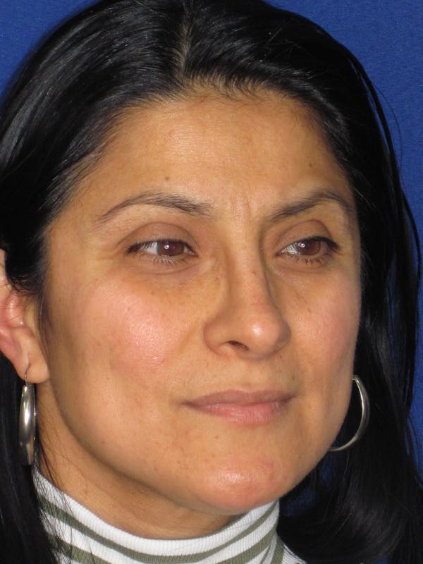 Rhinoplasty Before & After Gallery - Patient 303440 - Image 6