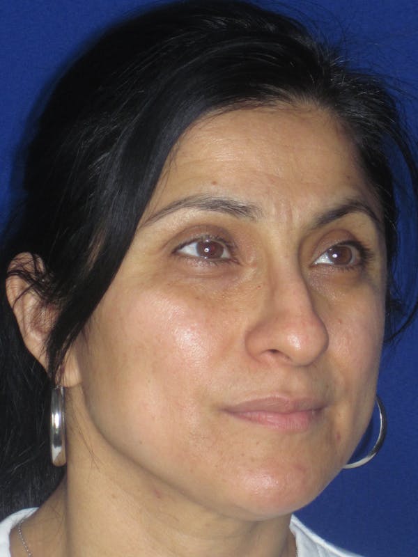 Rhinoplasty Before & After Gallery - Patient 303440 - Image 5