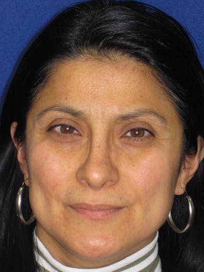 Rhinoplasty Before & After Gallery - Patient 303440 - Image 8