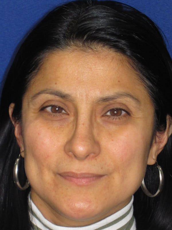 Rhinoplasty Before & After Gallery - Patient 303440 - Image 8