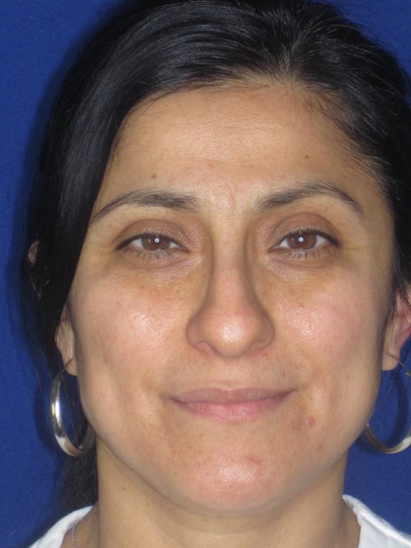 Rhinoplasty Before & After Gallery - Patient 303440 - Image 7