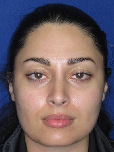 Rhinoplasty Before & After Gallery - Patient 611938 - Image 2