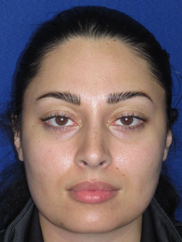 Rhinoplasty Before & After Gallery - Patient 611938 - Image 2