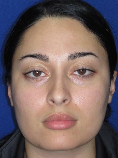 Rhinoplasty Before & After Gallery - Patient 611938 - Image 1