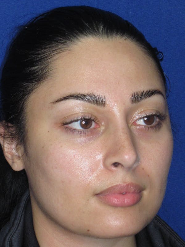 Rhinoplasty Before & After Gallery - Patient 611938 - Image 4