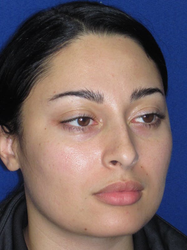 Rhinoplasty Before & After Gallery - Patient 611938 - Image 3