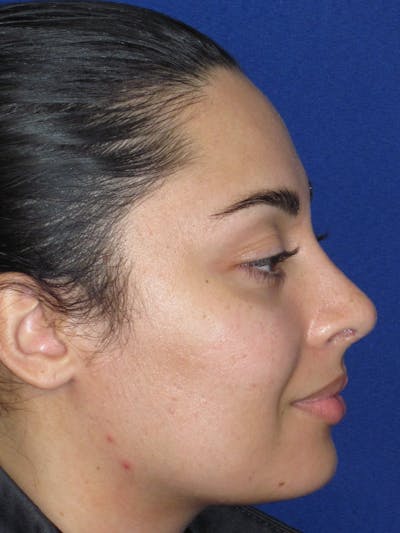 Rhinoplasty Before & After Gallery - Patient 611938 - Image 6