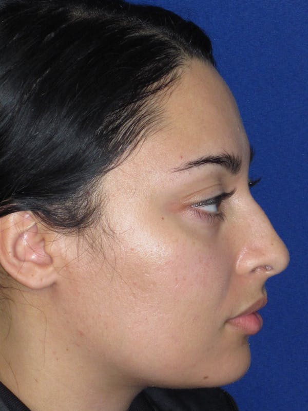 Rhinoplasty Before & After Gallery - Patient 611938 - Image 5