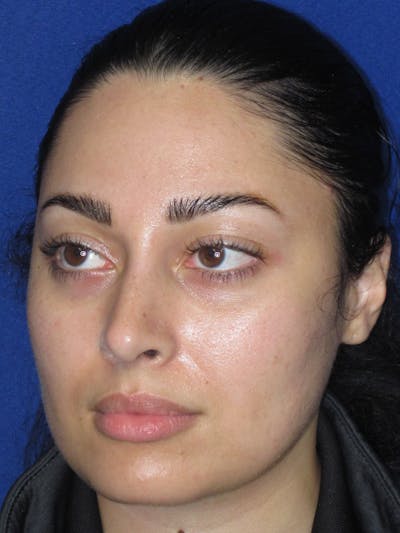 Rhinoplasty Before & After Gallery - Patient 611938 - Image 8