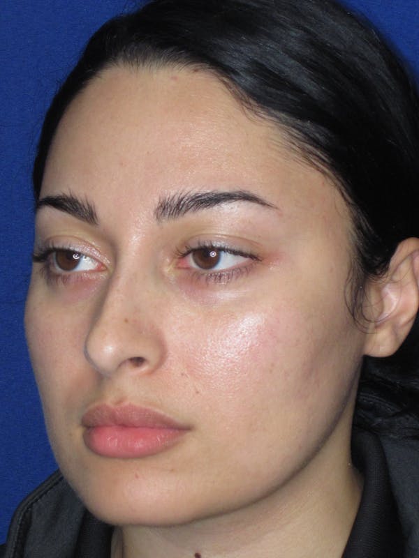 Rhinoplasty Before & After Gallery - Patient 611938 - Image 7