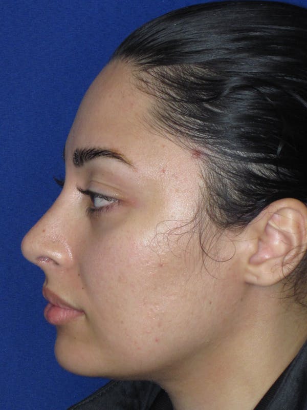 Rhinoplasty Before & After Gallery - Patient 611938 - Image 10