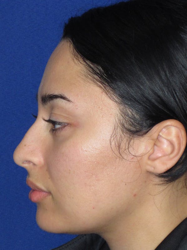Rhinoplasty Before & After Gallery - Patient 611938 - Image 9