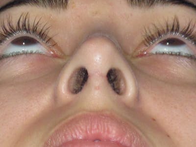 Rhinoplasty Before & After Gallery - Patient 611938 - Image 12