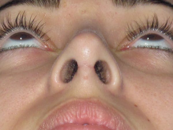 Rhinoplasty Before & After Gallery - Patient 611938 - Image 12