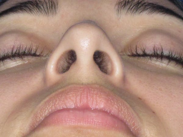 Rhinoplasty Before & After Gallery - Patient 611938 - Image 11