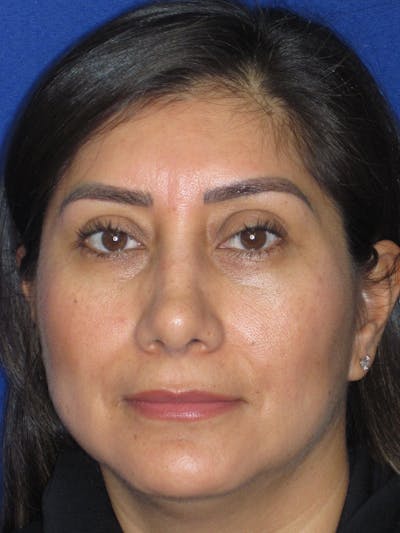 Rhinoplasty Before & After Gallery - Patient 344483 - Image 2