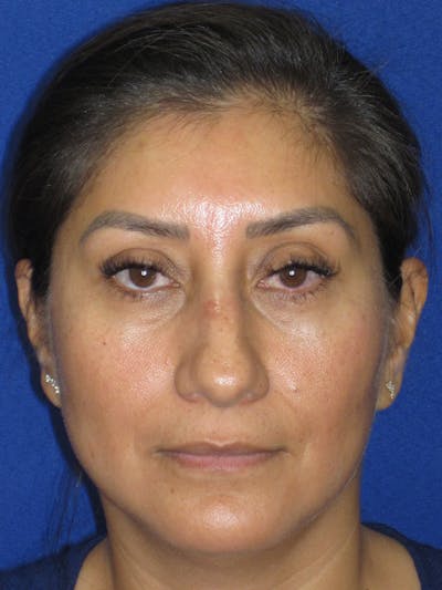 Rhinoplasty Before & After Gallery - Patient 344483 - Image 1