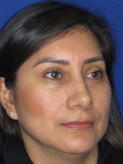 Rhinoplasty Before & After Gallery - Patient 344483 - Image 4