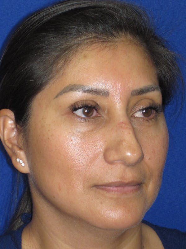 Rhinoplasty Before & After Gallery - Patient 344483 - Image 3